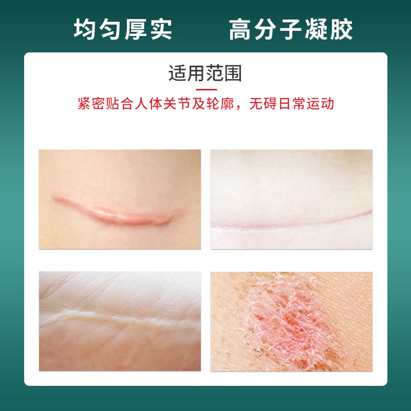 Silicone Gel Baby Ear Correction Patch Skin Tone Low Sensitivity Ear Shaping Tape for Protruding Ears 2 Rolls 2cm x 100cm - Image 3