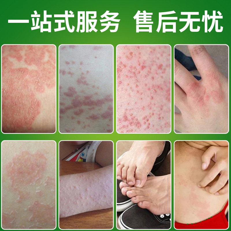 Shennong Baicao Skin Cream Herbal Ointment 20g External Use for Hand Care - Image 2