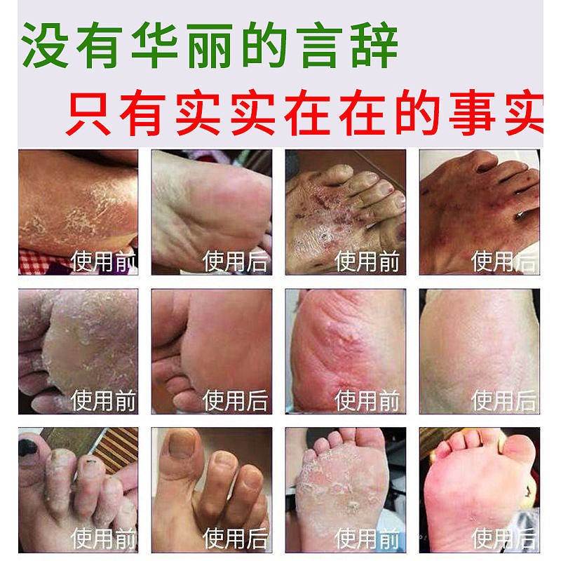 Snake King Itch Relief Ointment Herbal External Care for Foot Odor and Skin Itch 50g - Image 4